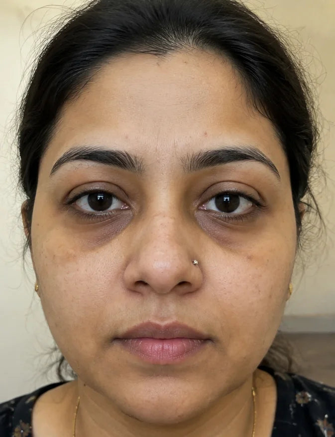 Dark Circle Treatment - Before