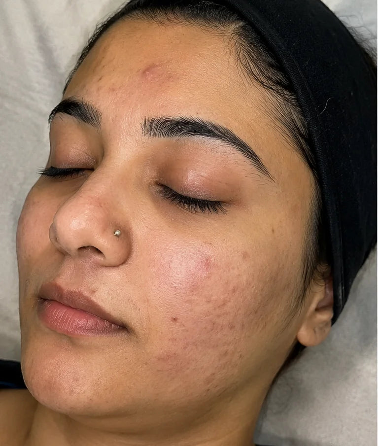 Medi Facial Treatment - After